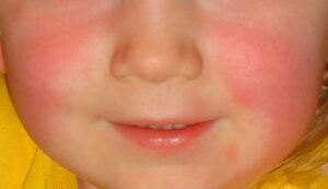 close da boca e bochechas de uma criança que está com escarlatina. A pele está com várias manchas vermelhas.