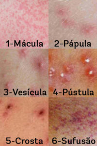 imagem das várias formas de exantemas: mácula, pápula, vesícula, pústula, crosta e sufusão